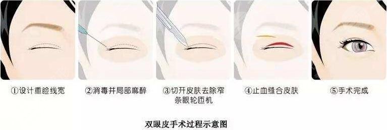 大连双眼皮手术哪家好?大连双眼皮做得好的医院汇总~