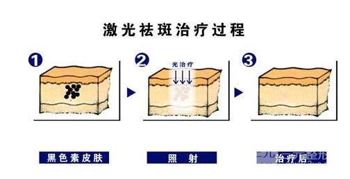 上海治疗雀斑多少钱？价格费用+比较好的医院